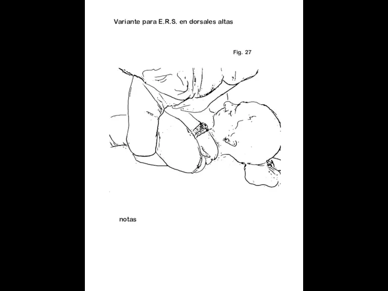 Fig. 27 notas Variante para E.R.S. en dorsales altas