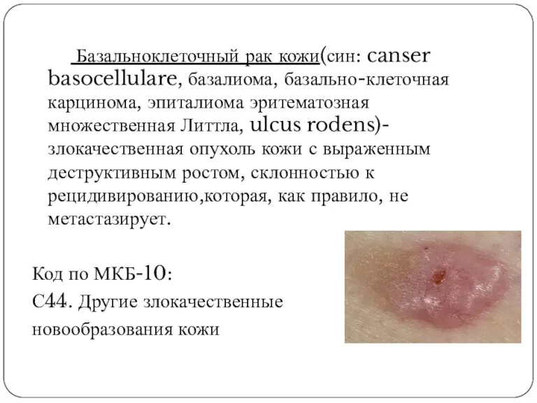 Базальноклеточный рак кожи(син: canser basocellulare, базалиома, базально-клеточная карцинома, эпиталиома эритематозная множественная Литтла,