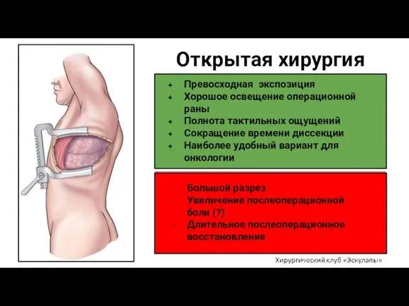 Открытая хирургия Превосходная экспозиция Хорошое освещение операционной раны Полнота тактильных ощущений Сокращение