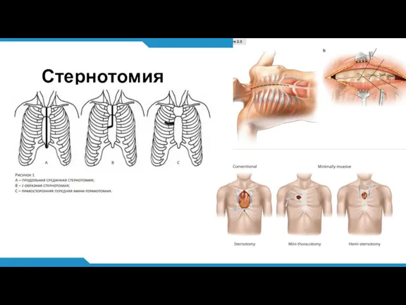 Стернотомия