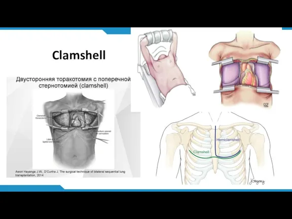 Clamshell