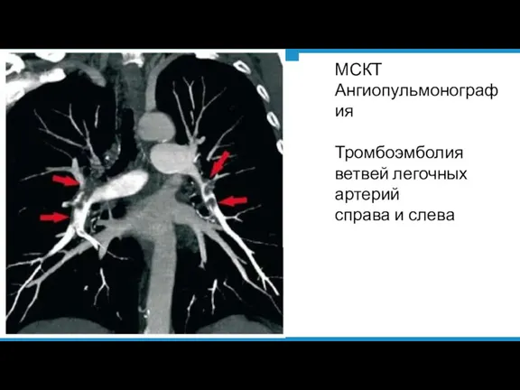 МСКТ Ангиопульмонография Тромбоэмболия ветвей легочных артерий справа и слева