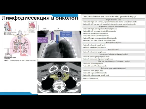 Лимфодиссекция в онкологии