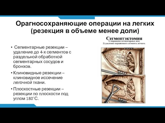 Орагносохраняющие операции на легких (резекция в объеме менее доли) Сегментарные резекции –