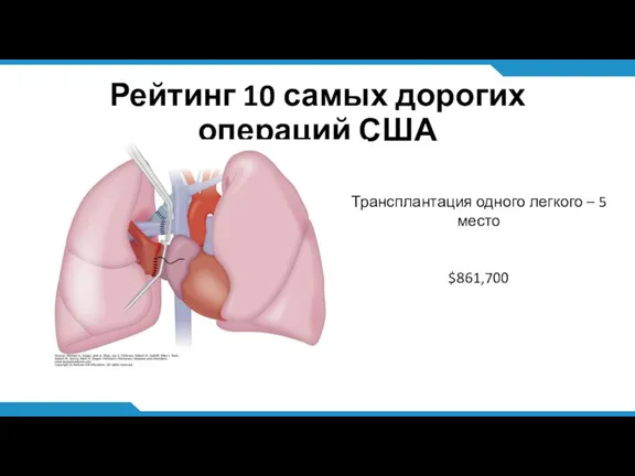 Рейтинг 10 самых дорогих операций США Трансплантация одного легкого – 5 место $861,700