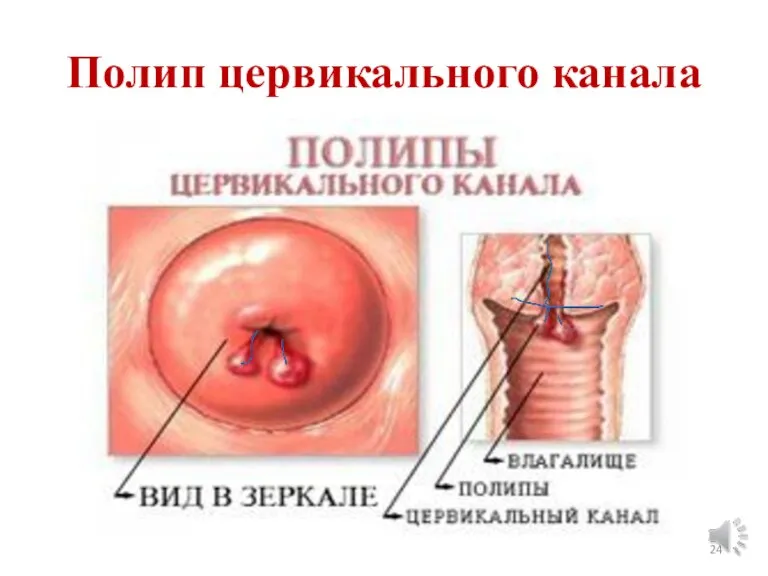 Полип цервикального канала