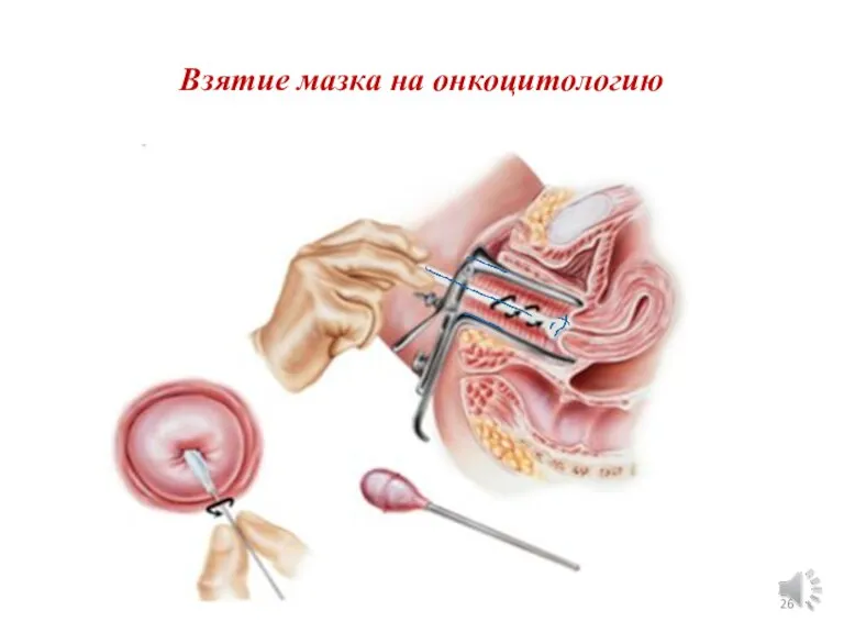 Взятие мазка на онкоцитологию