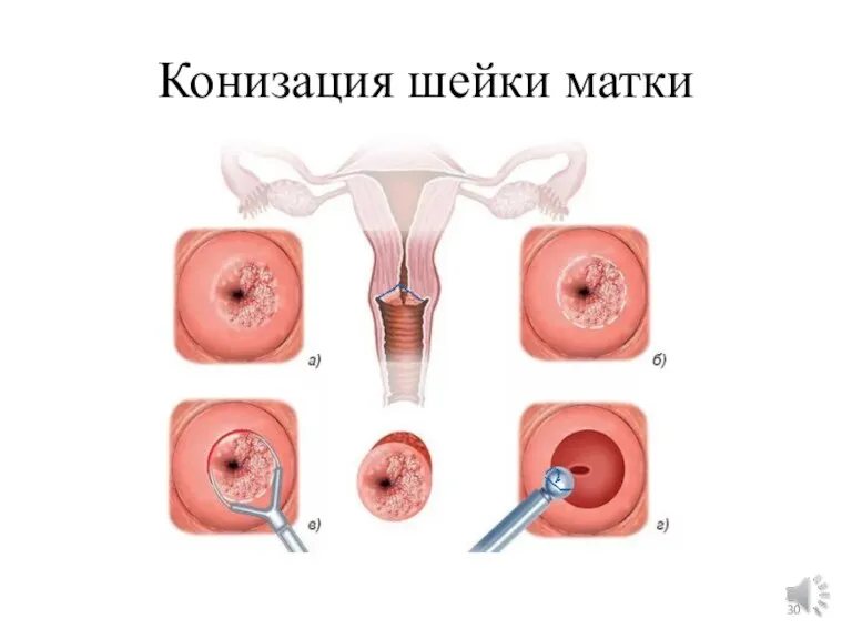 Конизация шейки матки