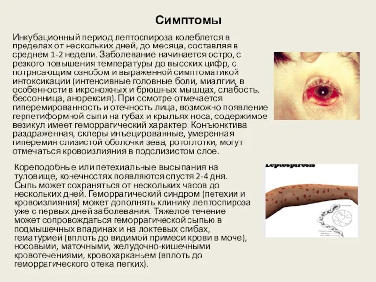 Симптомы Инкубационный период лептоспироза колеблется в пределах от нескольких дней, до месяца,