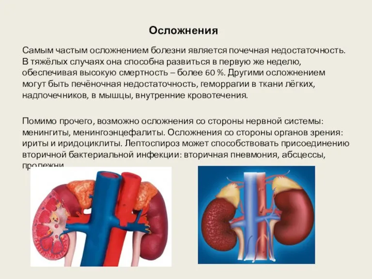 Осложнения Самым частым осложнением болезни является почечная недостаточность. В тяжёлых случаях она