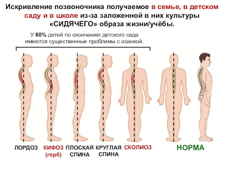 ЛОРДОЗ КИФОЗ (горб) ПЛОСКАЯ СПИНА КРУГЛАЯ СПИНА СКОЛИОЗ НОРМА У 80% детей