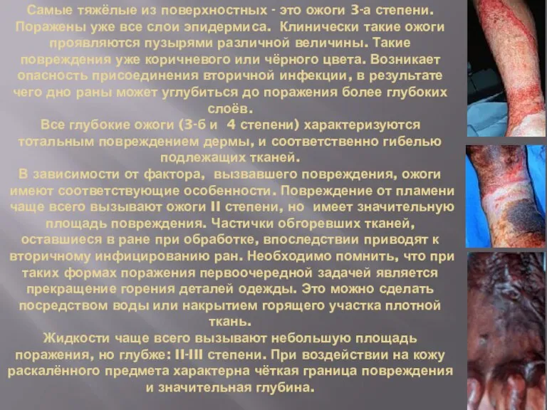 Самые тяжёлые из поверхностных - это ожоги 3-а степени. Поражены уже все