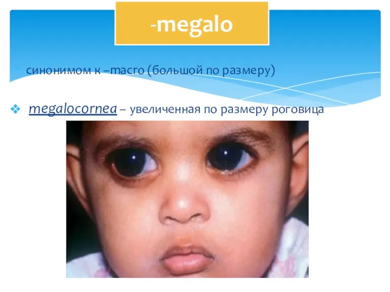 синонимом к –macro (большой по размеру) megalocornea – увеличенная по размеру роговица -megalo