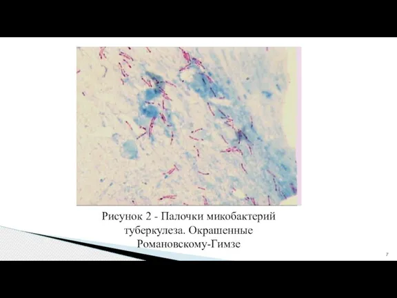 Рисунок 2 - Палочки микобактерий туберкулеза. Окрашенные Романовскому-Гимзе