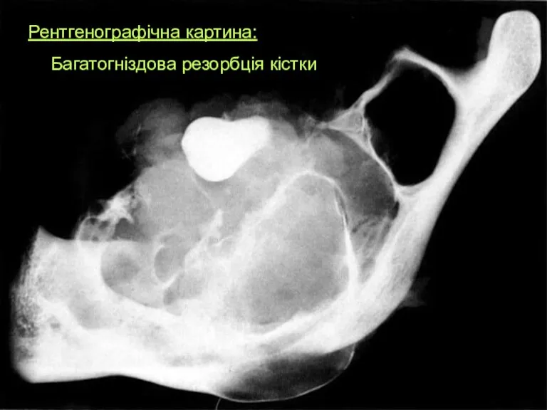 Рентгенографічна картина: Багатогніздова резорбція кістки
