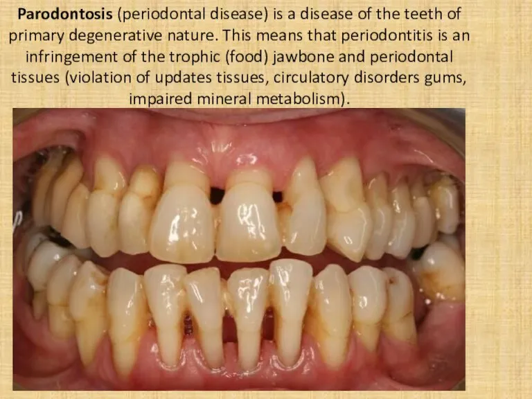 Parodontosis (periodontal disease) is a disease of the teeth of primary degenerative