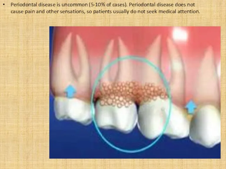 Periodontal disease is uncommon (5-10% of cases). Periodontal disease does not cause