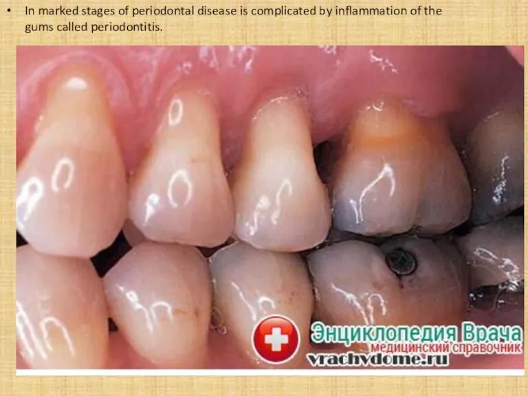 In marked stages of periodontal disease is complicated by inflammation of the gums called periodontitis.