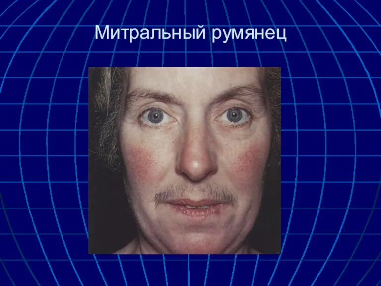 Митральный румянец