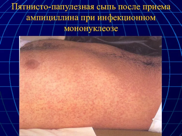 Пятнисто-папулезная сыпь после приема ампициллина при инфекционном мононуклеозе