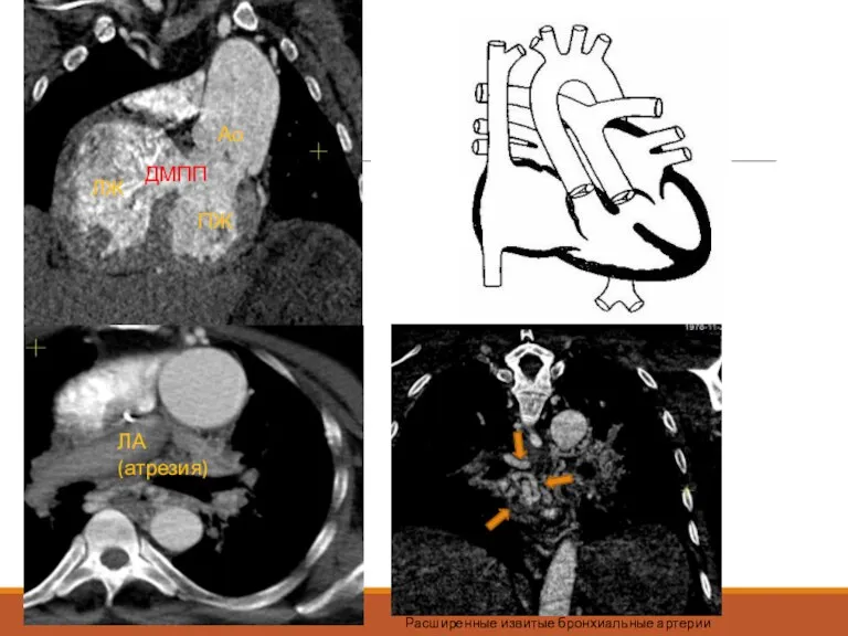 Ао ПЖ ЛЖ ЛА (атрезия) ДМПП Расширенные извитые бронхиальные артерии