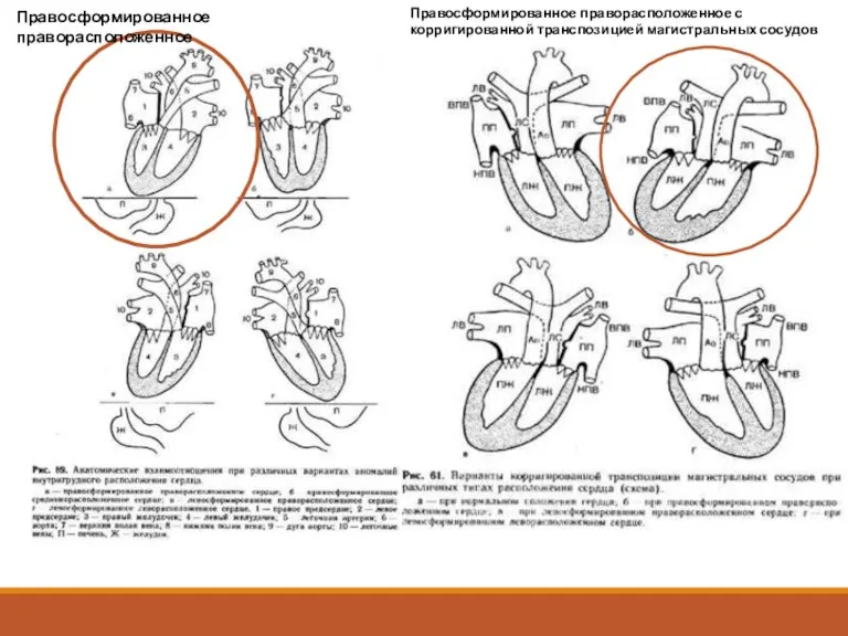 Правосформированное праворасположенное Правосформированное праворасположенное с корригированной транспозицией магистральных сосудов
