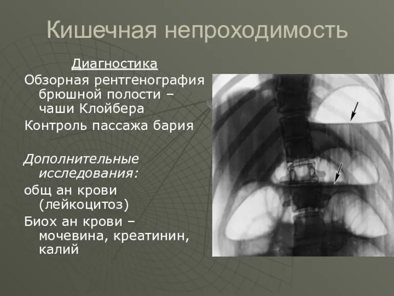 Кишечная непроходимость Диагностика Обзорная рентгенография брюшной полости – чаши Клойбера Контроль пассажа