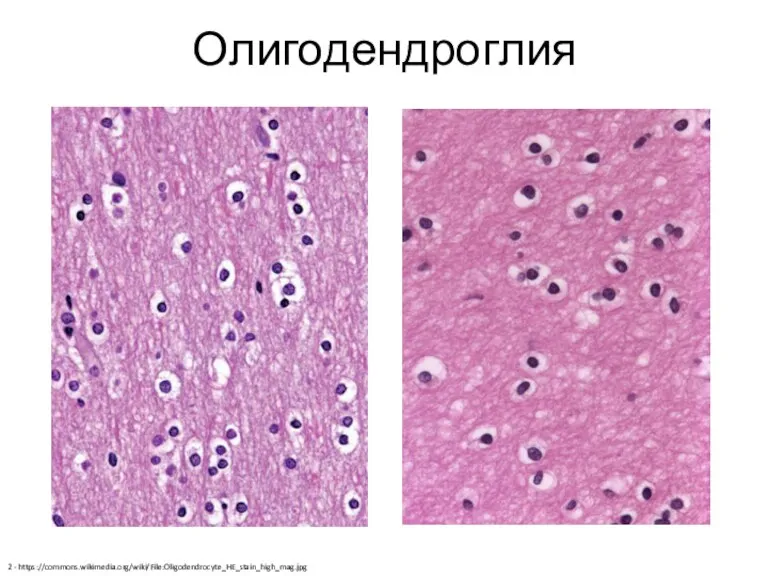 Олигодендроглия 2 - https://commons.wikimedia.org/wiki/File:Oligodendrocyte_HE_stain_high_mag.jpg