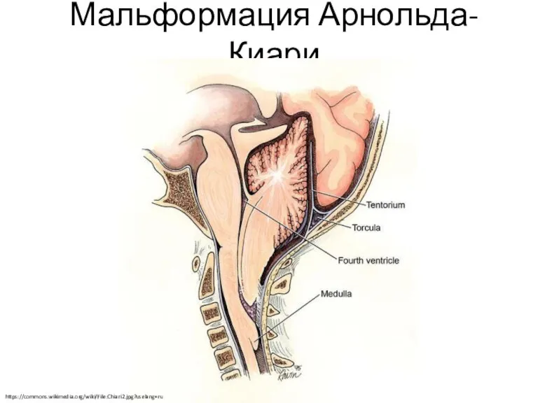 Мальформация Арнольда-Киари https://commons.wikimedia.org/wiki/File:Chiari2.jpg?uselang=ru