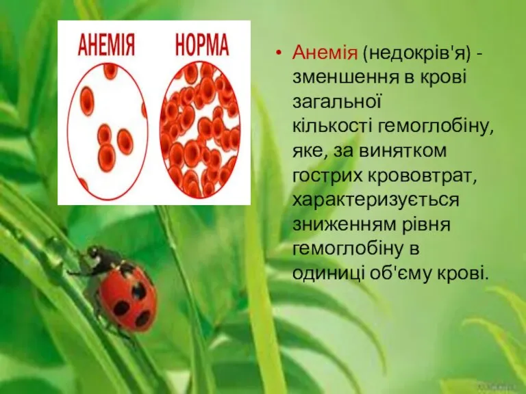 Анемія (недокрів'я) - зменшення в крові загальної кількості гемоглобіну, яке, за винятком