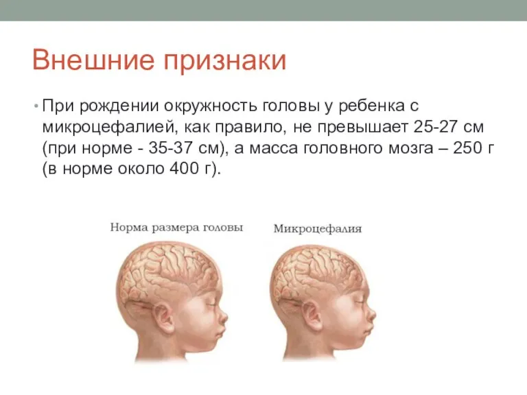 Внешние признаки При рождении окружность головы у ребенка с микроцефалией, как правило,