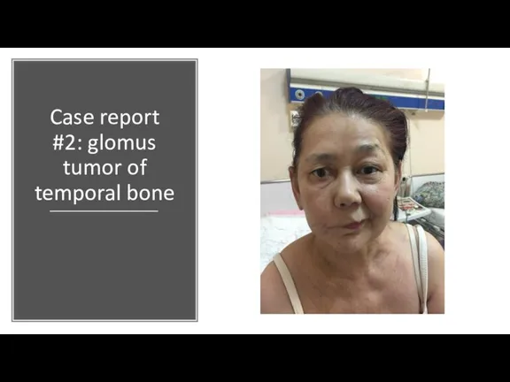 Case report #2: glomus tumor of temporal bone