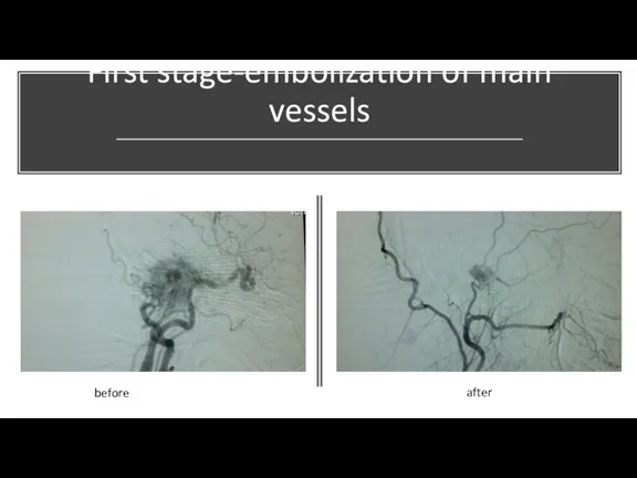 First stage-embolization of main vessels before after