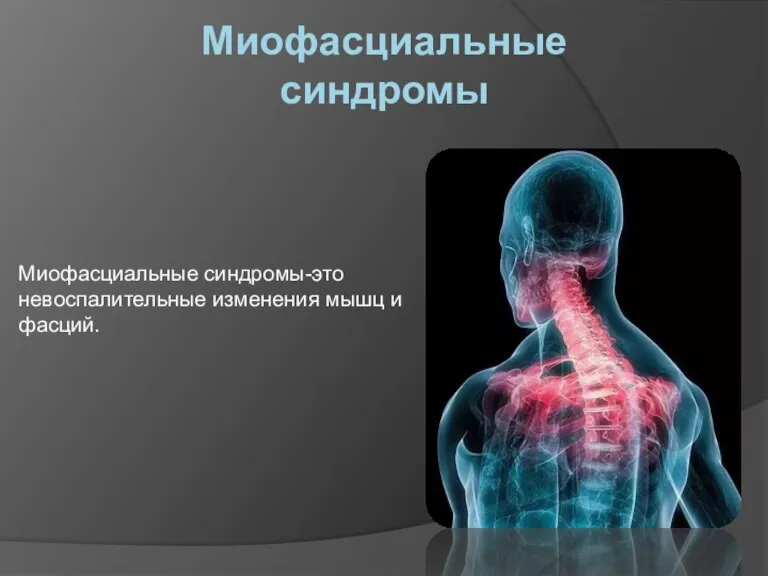 Миофасциальные синдромы Миофасциальные синдромы-это невоспалительные изменения мышц и фасций.