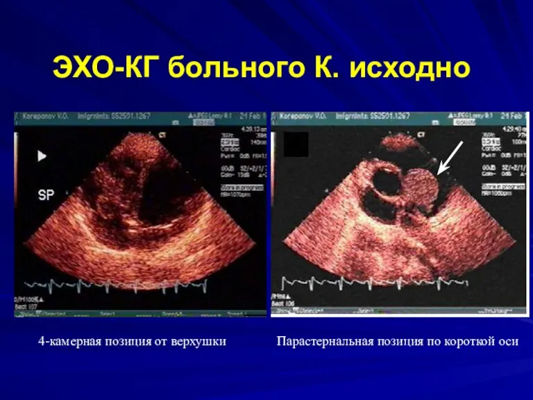 ЭХО-КГ больного К. исходно 4-камерная позиция от верхушки Парастернальная позиция по короткой оси