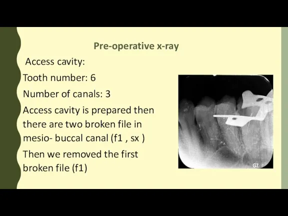 Pre-operative x-ray Access cavity: Tooth number: 6 Number of canals: 3 Access