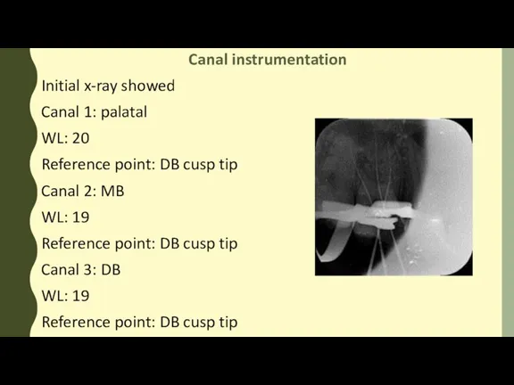 Canal instrumentation Initial x-ray showed Canal 1: palatal WL: 20 Reference point: