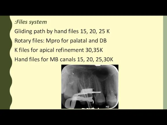 Files system: Gliding path by hand files 15, 20, 25 K Rotary