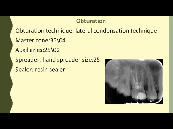 Obturation Obturation technique: lateral condensation technique Master cone:35\04 Auxiliaries:25\02 Spreader: hand spreader size:25 Sealer: resin sealer