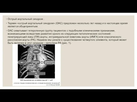 Острый аортальный синдром . Термин «острый аортальный синдром» (ОАС) предложен несколько лет