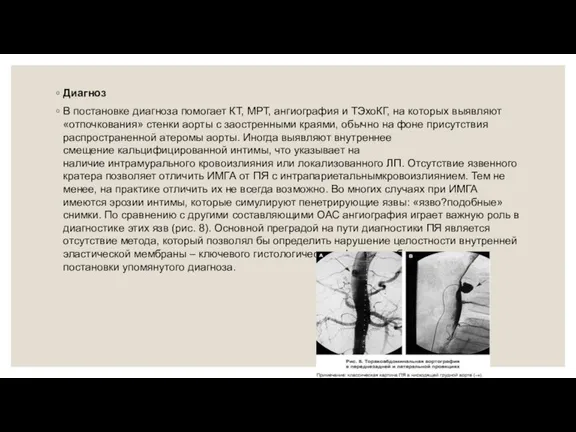 Диагноз В постановке диагноза помогает КТ, МРТ, ангиография и ТЭхоКГ, на которых