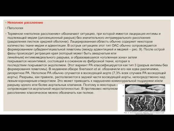 Неполное расслоение Патология Термином «неполное расслоение» обозначают ситуацию, при которой имеется лацерация