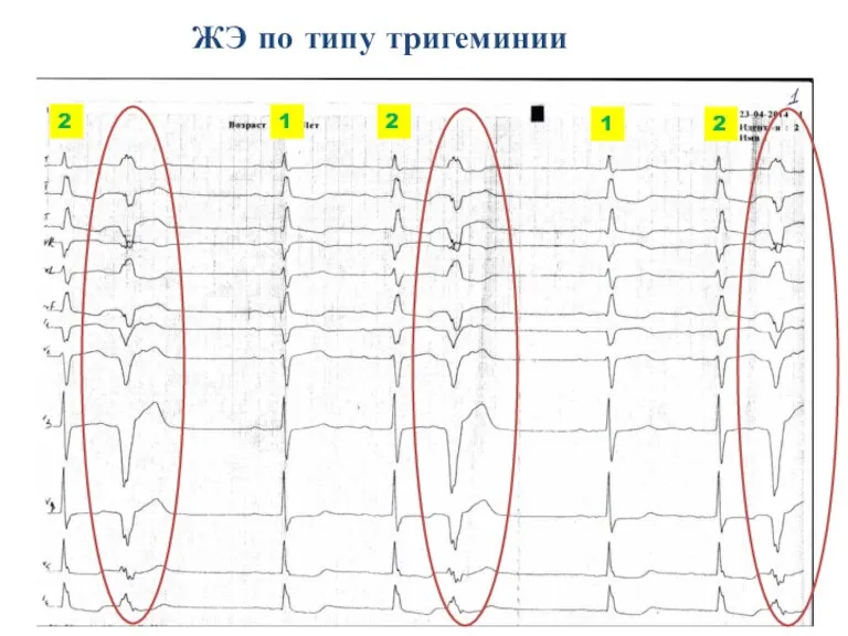 ЖЭ по типу тригеминии 1 2 1 2 2