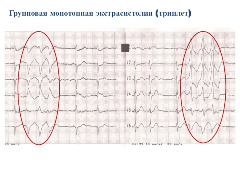 Групповая монотопная экстрасистолия (триплет)