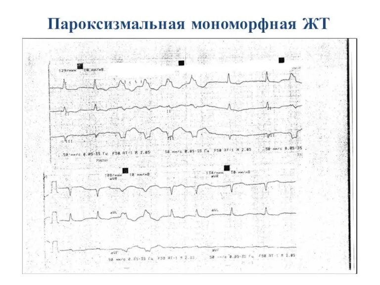 Пароксизмальная мономорфная ЖТ