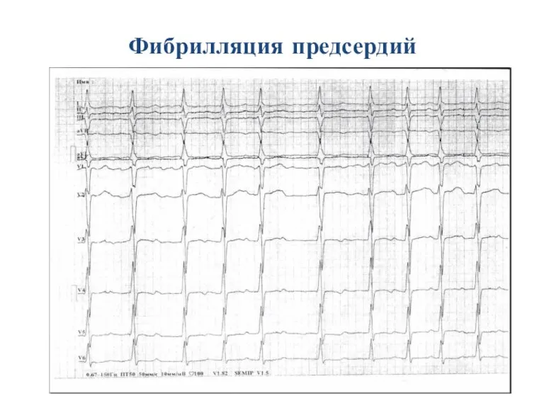 Фибрилляция предсердий