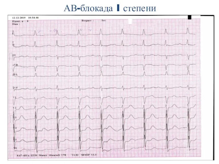 АВ-блокада I степени