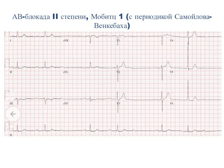 АВ-блокада II степени, Мобитц 1 (с периодикой Самойлова-Венкебаха)