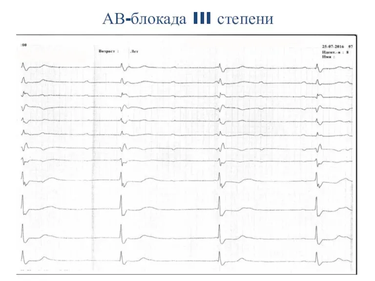 АВ-блокада III степени