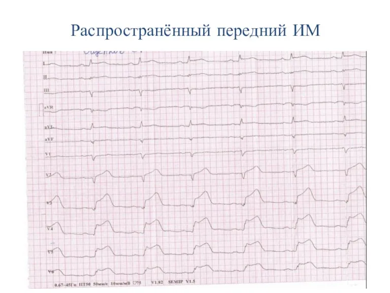 Распространённый передний ИМ